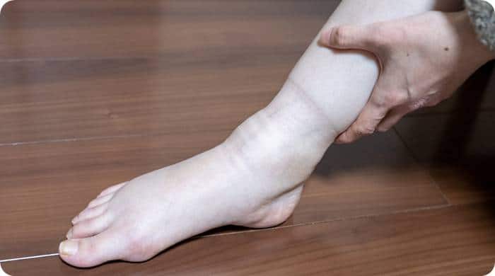 다리 붓기 빼는법 부은 다리 사진