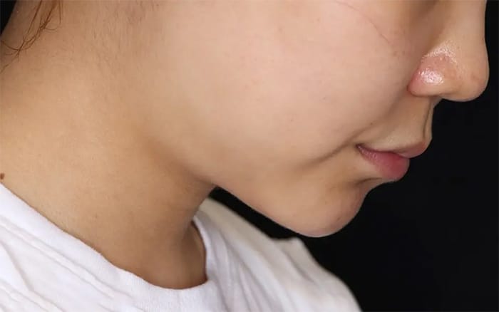 볼살 빼는법